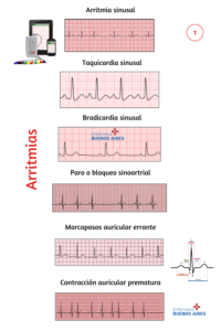 Arritmias