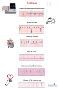 Arritmias