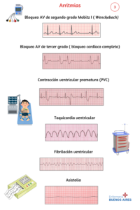 Arritmias