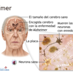 Alzheimer