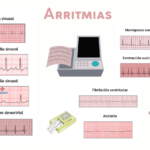 Arritmias